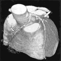 CAG (left) and plain and contrast-enhancement CT (middle and right, respectively) of 50-year-old man with angina pectoris.