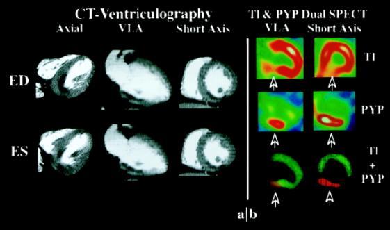 In addition to transaxial (axial) images, vertical long-axial (VLA) and short-axial images were obtained (a).