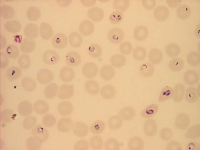 3. Differ in clinical manifestations Plasmodium falciparum Causes the most deadly and severe infections. Infects all ages of erythrocytes leading to a high parasitemia.