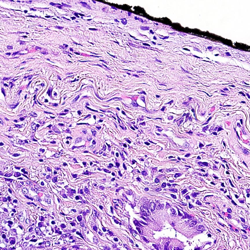 64 Cagle Fig. 1. No visceral pleural invasion is observed on this medium-power hematoxylin and eosin (H&E) stained section.