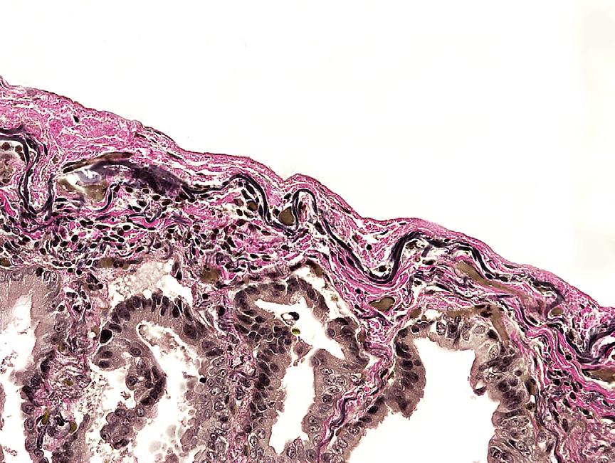 An adenocarcinoma can be observed beneath the external elastic lamina of the visceral pleura without penetration of the lamina. The visceral pleural surface has been stained with black ink.