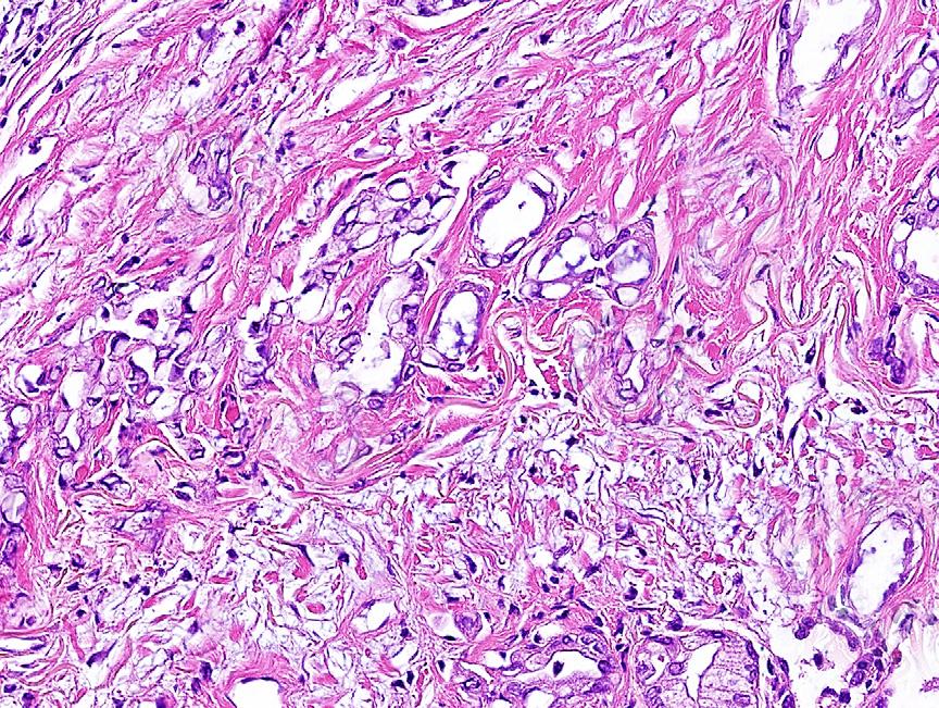 Lung Carcinoma Staging Problems 65 Fig. 3. Visceral pleural invasion can be seen in this medium-power H&Estained section in which adenocarcinomais present on both sides of the external elastic lamina.