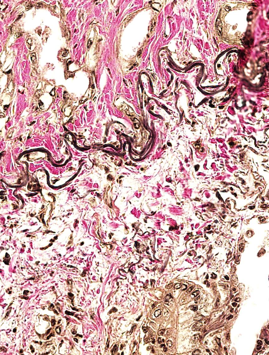66 Cagle Fig. 4. In this high-power VVG-stained section, visceral pleural invasion is indicated by the presence of adenocarcinoma on both sides of the black, wavy, external elastic lamina.