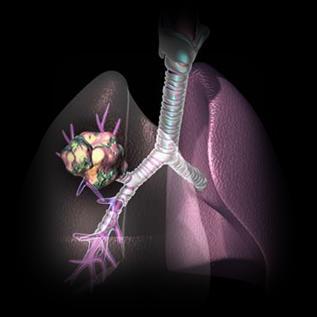 edu LEARNING OBJECTIVES Understanding lung cancer