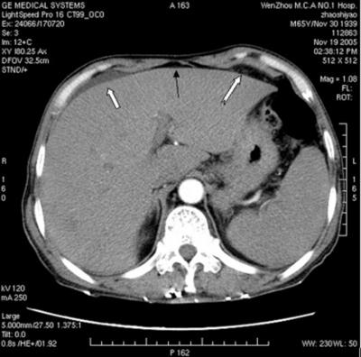 2, 3, 4, 5 Figure 2 Figure 2: Pre-contrast CT scan showed asymmetric and triangular hepatomegaly with the apex at the falciform