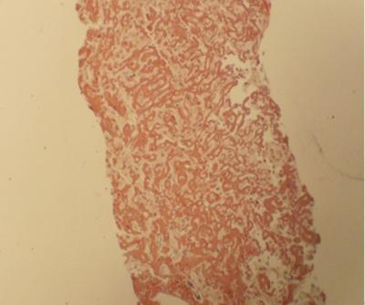 an amorphous eosinophilic material that stained with Congo red. Amyloid deposit along the sinusoidal wall and marked atrophy of the liver cell cord were observedfig. 6, 7.