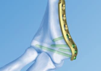 for multiple fixation options for the distal block Position and compression device available Aiming block for easy and correct screw insertion Portfolio Dorsolateral plates with or without support