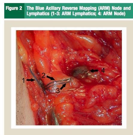 Study of Axillary Reverse Mapping Results ARM successful in 129 cases (93%) ARM nodes