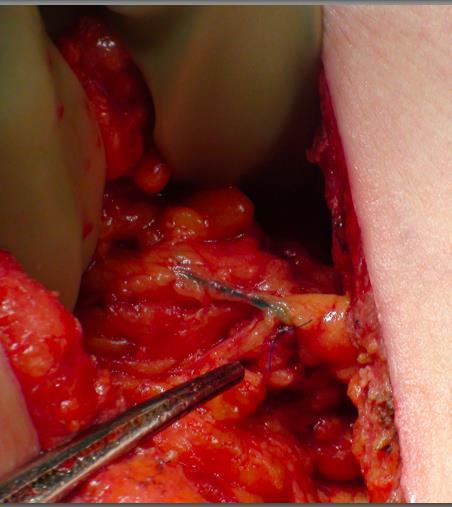 Primary Repair During ALND for cross over nodes Primary anastamosis Place ends