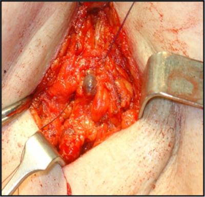 Opening of the superficial fascia was followed by incision of the clavipectoral fascia and searching for the blue-dyed lymphatics that lead to the presumed sentinel node (Photo 2).