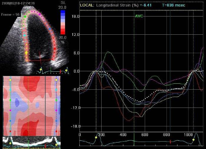 Echocardiography and Myocardial strain analysis 10% drop in GLS