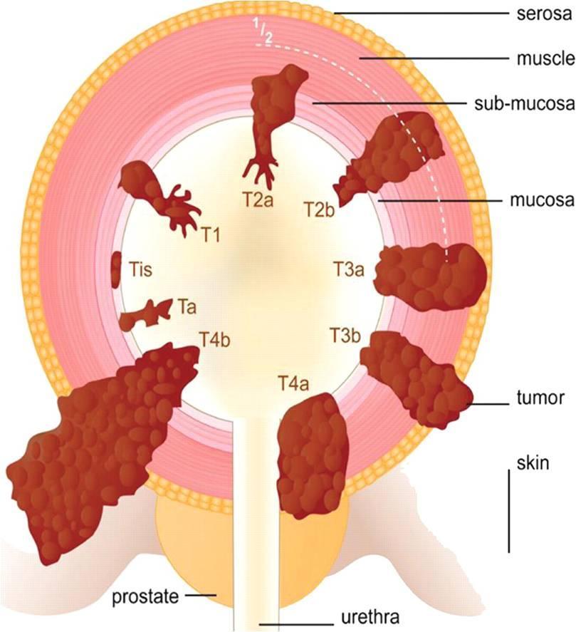 Bladder tumour staging Tumour grading Grading refers to the how the cancer cells appear on the microscope. Grade one is one factor to predict how likely the cancer is to recur after treatment.