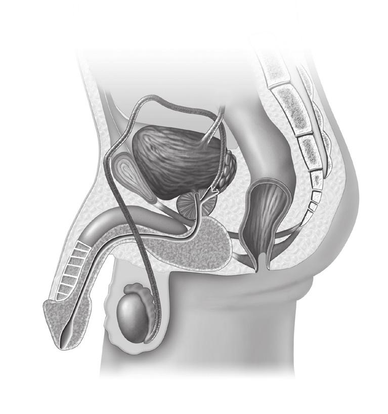 A cystoscope (a thin, lighted tube) is inserted into the bladder through the urethra. A tool with a small wire loop on the end removes or burns away the tumor. TURB in women.