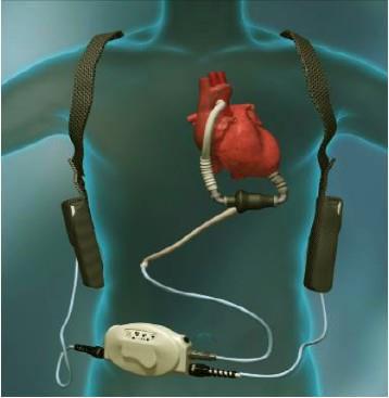 HeartMate II LVAD Surgically placed longterm LVAD Battery