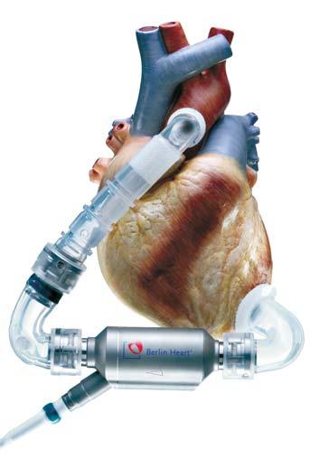 Apart from the MicroMed DeBakey Child, it is the first FDA-approved newer generation continuous flow LVAD, and the first FDA-approved device for BTT since the inception of INTERMACS.