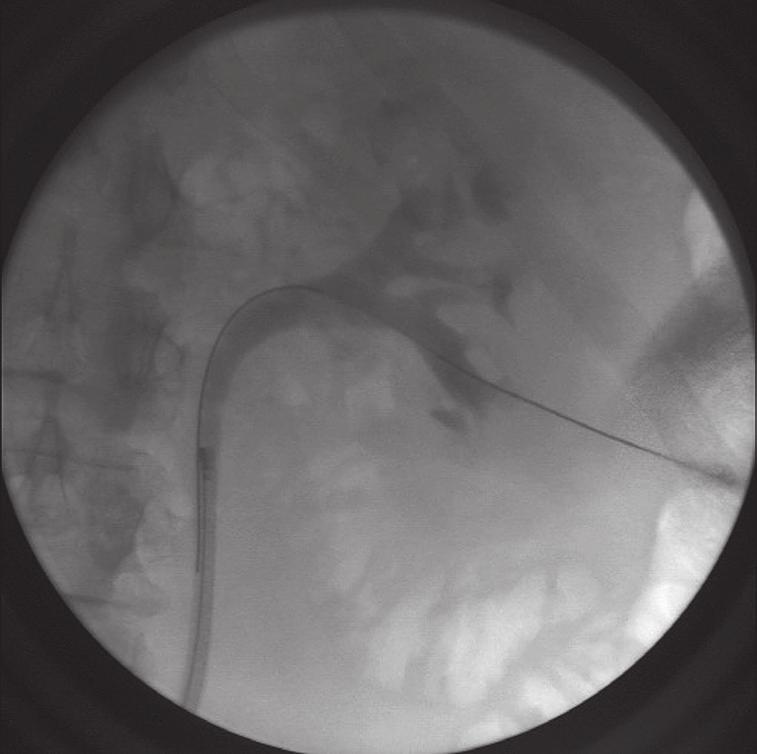obtain access. Formation of AVFs following PCNL manifesting as gross hematuria is well described in the literature; these fistulas are typically successfully managed with renal angio-embolization (4).