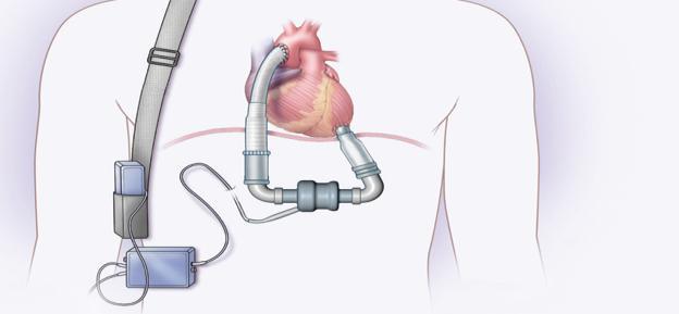 considered candidates for additional surgery, it provides destination therapy. Intra-Aortic Balloon Pump: A counterpulsation balloon synchronized to the EKG or arterial waveforms.