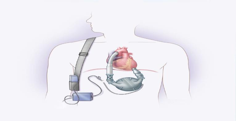 Slaughter et al., Advanced Heart Failure Treated with Continuous-Flow LVAD NEJM 361:23 Dec 3, 2009 I. Etiologies of Cardiac Failure: Indications for VAD A. Cardiomyopathy (congenital or acquired) B.