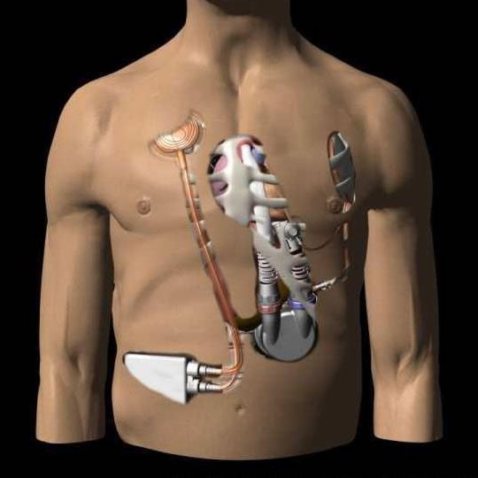 C. The Berlin Heart: A long-term pulsatile ventricular assist device (VAD), which can provide support of the left or right ventricle (LVAD/RVAD) or serve as a biventricular device (BiVAD) in heart
