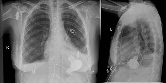 Pericardial Placement of HVAD