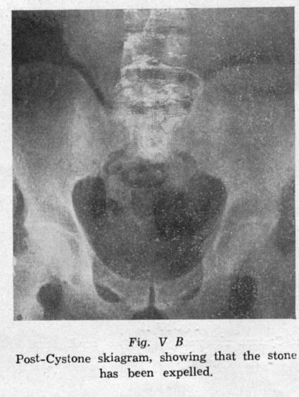 Crossing the left iliac artery 5 5.5 c. Juxtaposition of vas deferens or 7 7.8 broad ligament d. Entering bladder wall 8 8.9 e. Ureteric orifice 6 6.