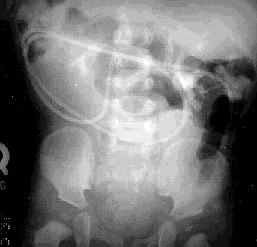FIGURE 1a. Bilateral staghorn calculi. Conventional abdominal radiograph demonstrates a left complete and a right partial staghorn calculi. VP shunt is noted. FIGURE 1b.