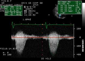 Baseline Echocardiography Peak AV