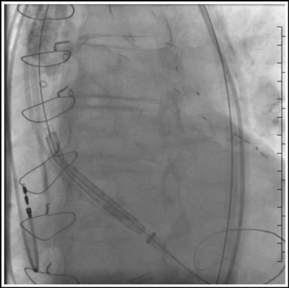 Optimal Starting Position Pigtail in noncoronary cusp Oval Radiopaque