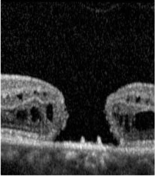 Stage 4 macular hole [3]. Full thickness as in stage 3 plus operculum and separation of vitreous.