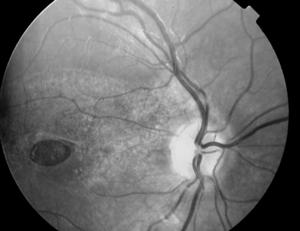 page 2 What s your diagnosis? See page 3 Update on Choroidal Melanoma Posterior uveal melanoma is an uncommon disease with approximately six new cases for every one million people per year.