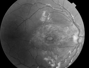 page 3 Case Presentation: Traumatic Macular Hole 10 days after surgery with silicone oil RW is a 3-year-old young boy who was struck in the right eye by a tennis ball that was propelled by a baseball