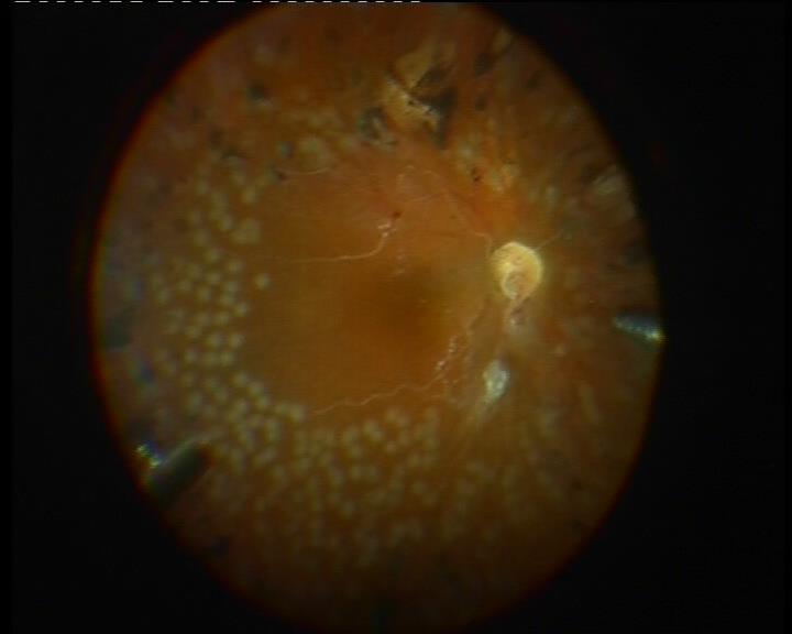 scleral buckling in fellowship