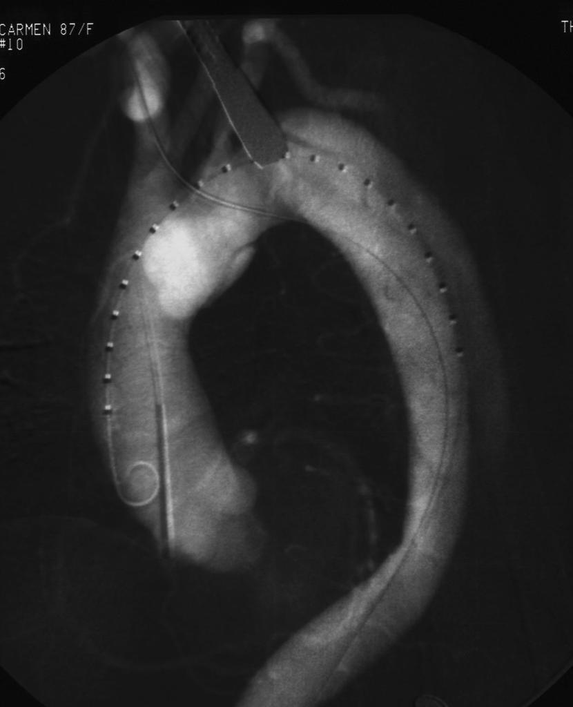 86-year-old woman with acute