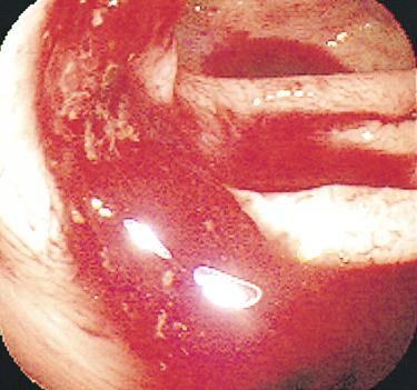 16 Sigmoid colon view of a bleeding diverticulum in a 68year-old man on one aspirin per day after the bleeding was
