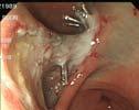 Lewis operation for esophageal