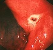 Document healing of GASTRIC ulcer Repeat EGD in 8 weeks NSAID Prophylaxis: Risk Factors High Risk for NSAID complications 1. Previous complicated ulcer 2.