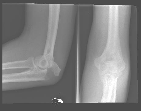 Olecranon fractures Hairline and undisplaced fractures can be treated in long arm cast for 3-43 weeks in
