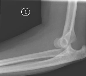 Elbow dislocation Usually fall onto outstretched hand Severe