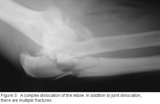 Elbow Dislocations BEWARE ASSOCIATED FRACTURES BEWARE