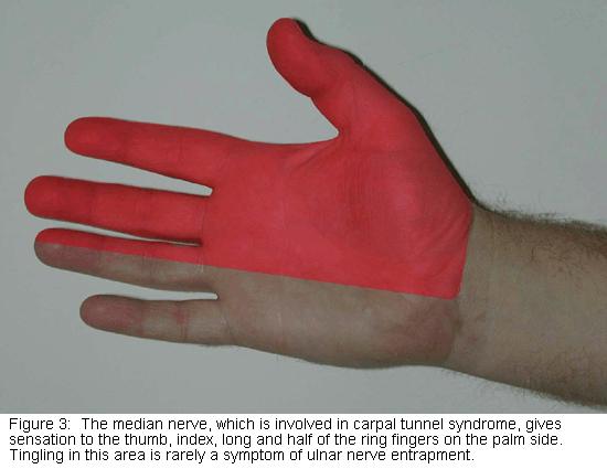 Median Nerve Injury Occasionally damaged in supracondylar fractures More commonly in wrist lacerations Produces loss of