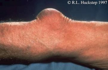 Olecranon Bursitis Infection/inflamma tion of bursa Causes- Trauma