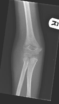 Supra-condylar fracture Usually from fall onto elbow when flexed More common in
