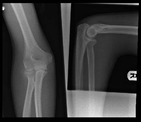 Radial head fractures Fall onto outstretched hand
