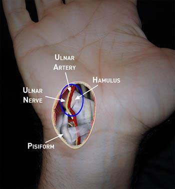 Guyon s Canal Syndrome Relevant anatomy Contiguous with carpal tunnel Pisiform and hook of hamate