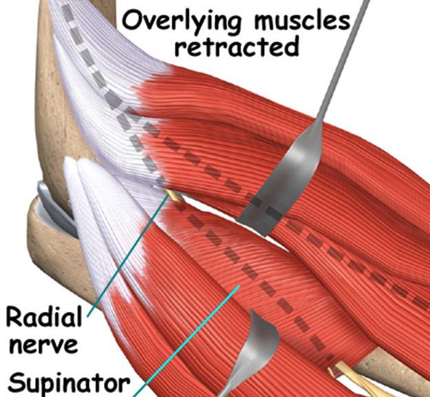Radial Tunnel Syndrome Relevant Anatomy Posterior Interosseous Nerve branch of radial nerve Arcade of Frohse