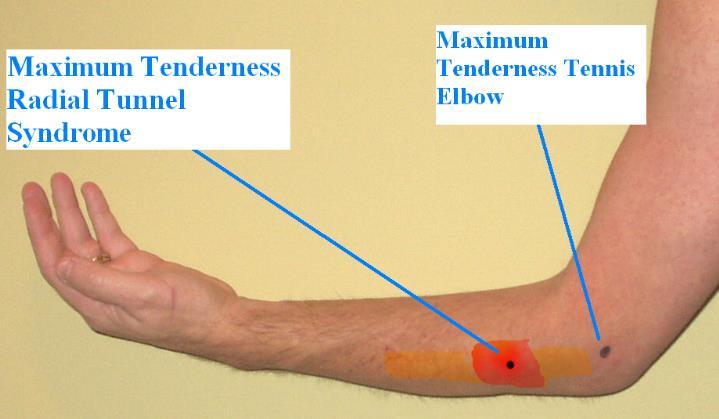 Clinical Diagnosis Pressure over Arcade of Frohse Radial Tunnel Syndrome Resisted long finger extension or passive long finger flexion during wrist and finger