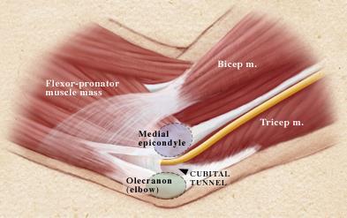 Cubital Tunnel Syndrome Cubital Tunnel Syndrome Numbness, tingling, weakness Second most common