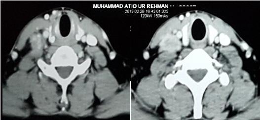 Thyroid gland was essentially normal on radiological grounds and no evidence of Pancoast tumor was noted (Figure 2).
