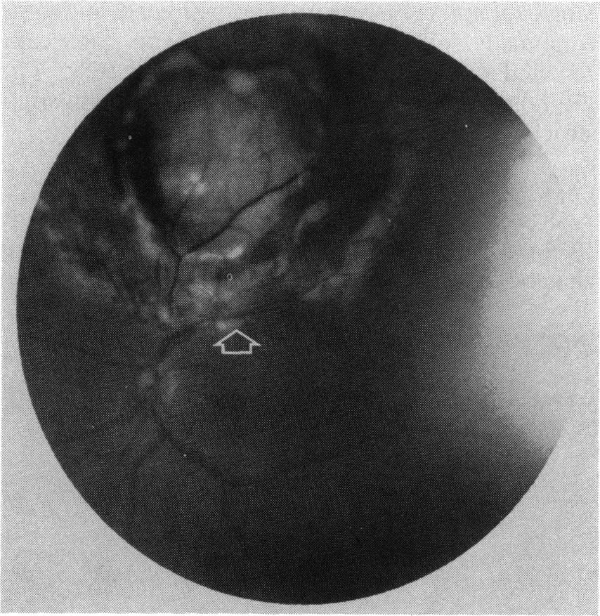 She denied previous ocular symptoms. Her past history included excision of a naevus from her groin 15 years earlier.