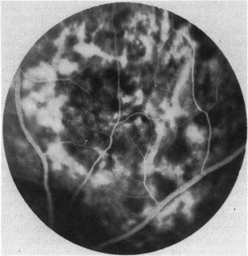 CASE 4 A 64-year-old man was seen in February 1981 after referral by his ophthalmologist for examination of a tumour in his left eye.